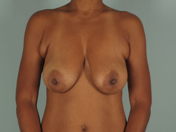 Breast Auto-Augmentation