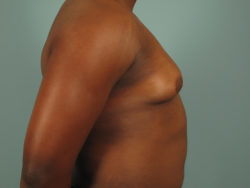 Male Breast Reduction/ Gynecomastia
