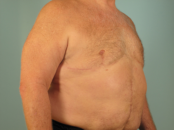 Male Breast Reduction/ Gynecomastia